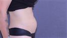 Tummy Tuck - TWT Health Tourism