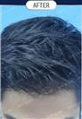 FUT Hair Transplant - DHT HAIR CLINIC