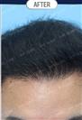 FUT Hair Transplant - DHT HAIR CLINIC