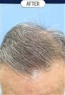 FUT Hair Transplant - DHT HAIR CLINIC