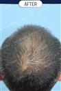FUT Hair Transplant - DHT HAIR CLINIC