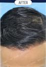 FUT Hair Transplant - DHT HAIR CLINIC