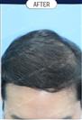 FUT Hair Transplant - DHT HAIR CLINIC