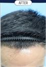 FUT Hair Transplant - DHT HAIR CLINIC