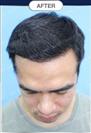 FUT Hair Transplant - DHT HAIR CLINIC
