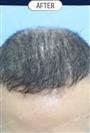 FUT Hair Transplant - DHT HAIR CLINIC