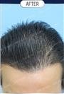 FUT Hair Transplant - DHT HAIR CLINIC