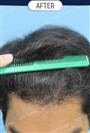 FUT Hair Transplant - DHT HAIR CLINIC