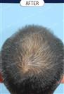 FUT Hair Transplant - DHT HAIR CLINIC