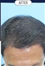 FUT Hair Transplant - DHT HAIR CLINIC