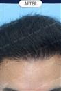 FUT Hair Transplant - DHT HAIR CLINIC