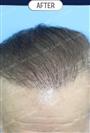 FUT Hair Transplant - DHT HAIR CLINIC