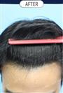FUT Hair Transplant - DHT HAIR CLINIC