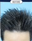 FUT Hair Transplant - DHT HAIR CLINIC