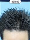 FUT Hair Transplant - DHT HAIR CLINIC