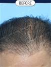 FUT Hair Transplant - DHT HAIR CLINIC