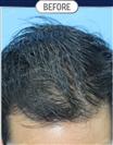 FUT Hair Transplant - DHT HAIR CLINIC