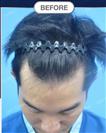 FUT Hair Transplant - DHT HAIR CLINIC