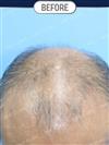 FUT Hair Transplant - DHT HAIR CLINIC