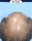 FUT Hair Transplant - DHT HAIR CLINIC