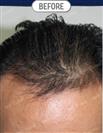 FUT Hair Transplant - DHT HAIR CLINIC