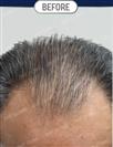 FUT Hair Transplant - DHT HAIR CLINIC