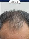 FUT Hair Transplant - DHT HAIR CLINIC