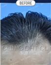 FUT Hair Transplant - DHT HAIR CLINIC