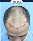 FUT Hair Transplant - DHT HAIR CLINIC