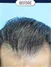 FUT Hair Transplant - DHT HAIR CLINIC