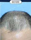 FUT Hair Transplant - DHT HAIR CLINIC