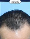 FUT Hair Transplant - DHT HAIR CLINIC