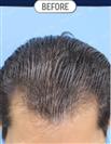 FUT Hair Transplant - DHT HAIR CLINIC