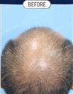 FUT Hair Transplant - DHT HAIR CLINIC