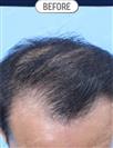 FUT Hair Transplant - DHT HAIR CLINIC