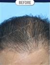 FUT Hair Transplant - DHT HAIR CLINIC