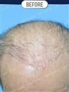 FUT Hair Transplant - DHT HAIR CLINIC