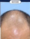 FUT Hair Transplant - DHT HAIR CLINIC
