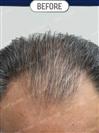 FUT Hair Transplant - DHT HAIR CLINIC