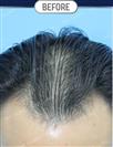FUT Hair Transplant - DHT HAIR CLINIC