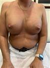 Breast Augmentation - Liv Duna Medical Center