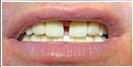 Crowns - Fulop Clinic