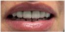 Crowns - Fulop Clinic