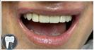 Crowns - Fulop Clinic