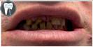 Crowns - Fulop Clinic