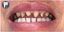 Crowns - Fulop Clinic