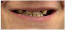 Crowns - Fulop Clinic
