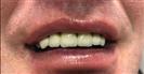 Dental Implants - Fulop Clinic