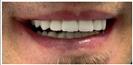 Dental Implants - Fulop Clinic