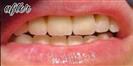 Dental Implants - Fulop Clinic